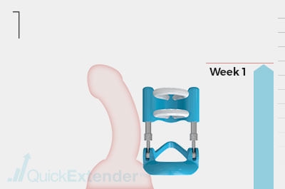 The Quick Extender Pro For Peyronies